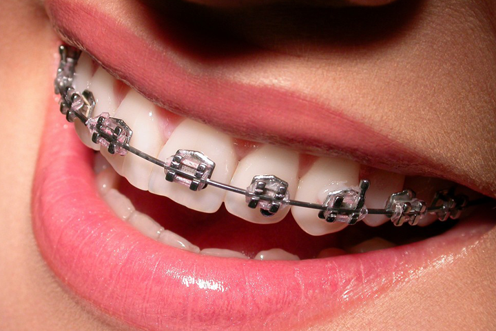 different types of braces