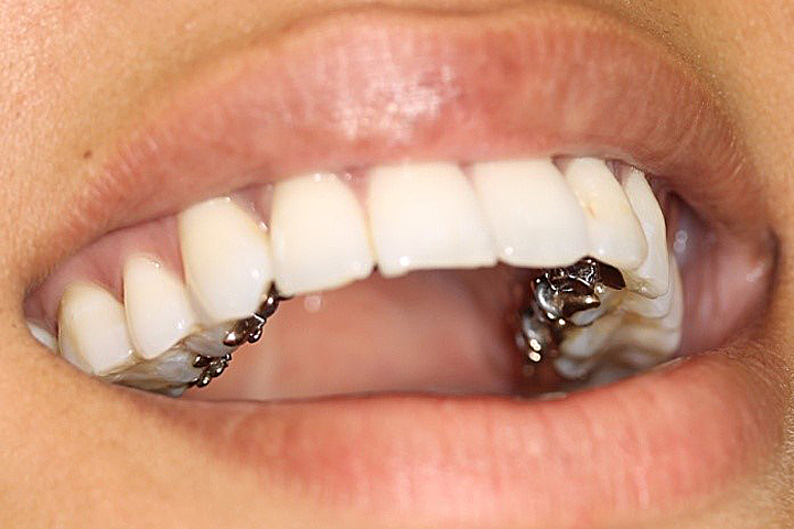 types of braces sylmar orthodontics sylmar ca lingual braces